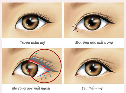 mở góc mắt