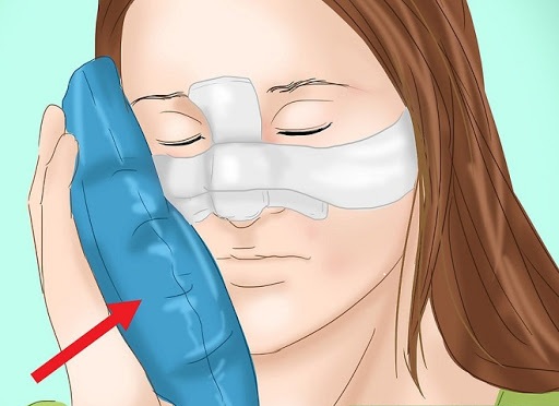 Vệ sinh mũi và chườm lạnh sau khi nâng mũi