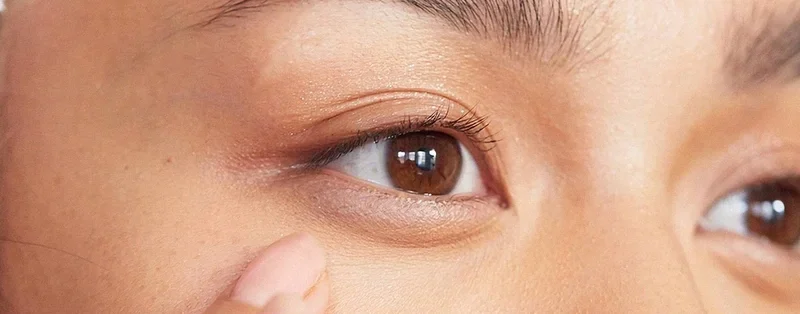 4 Cách Khắc Phục Bọng Mỡ Mí Mắt 2 Bọng mí mắt là gì?