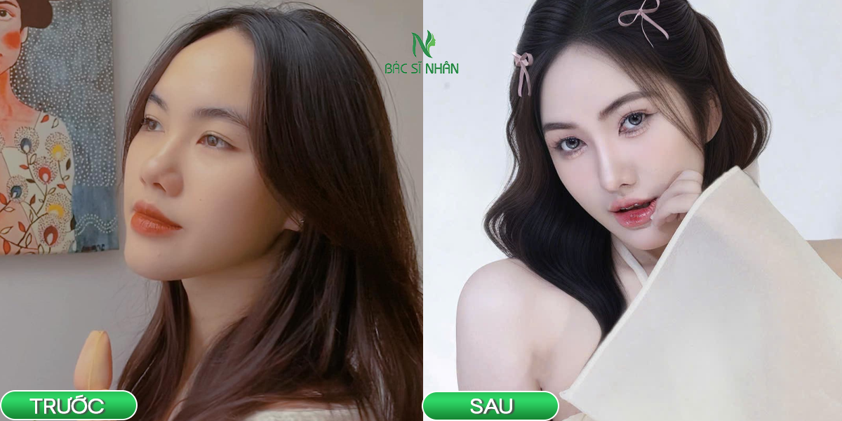 ĐỊA CHỈ NÂNG MŨI ĐÀ NẴNG UY TÍN VÀ AN TOÀN