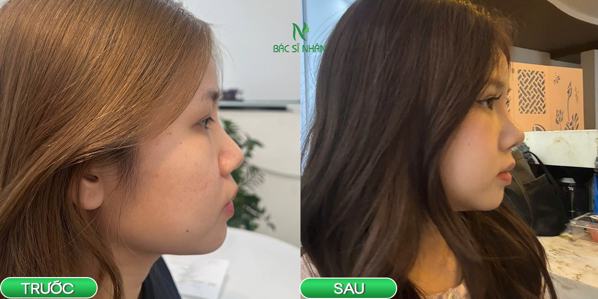 ĐỊA CHỈ NÂNG MŨI ĐÀ NẴNG UY TÍN VÀ AN TOÀN