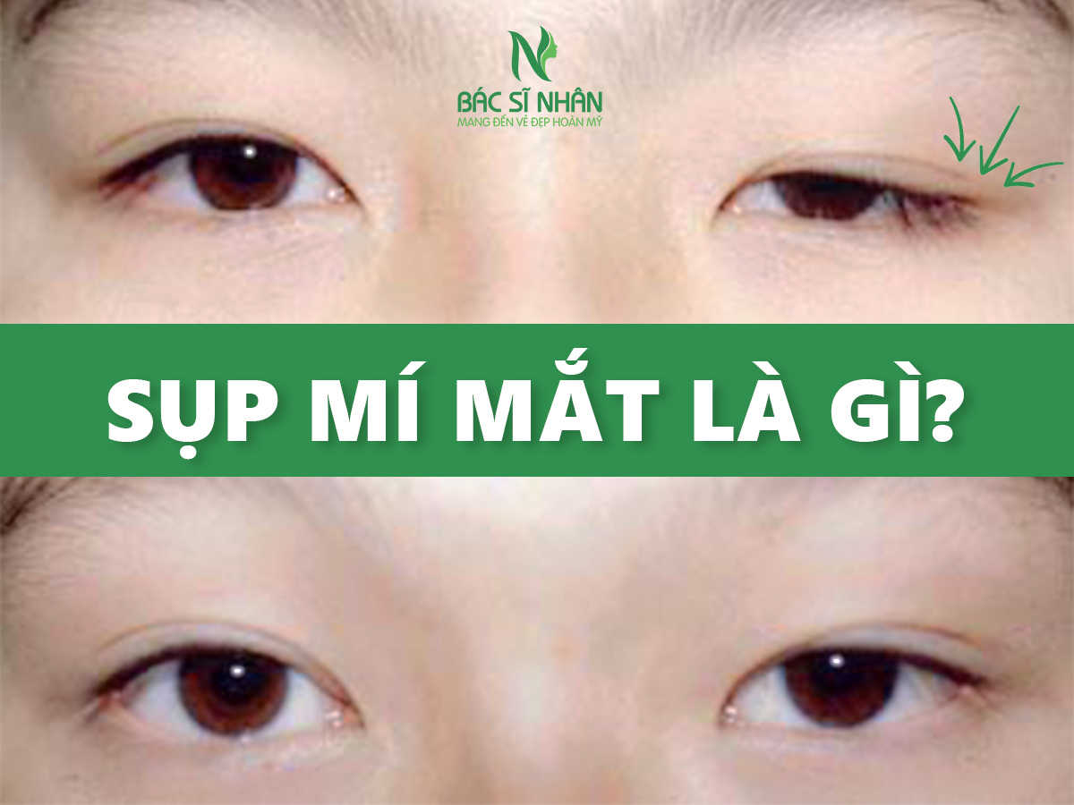 SỤP MÍ MẮT LÀ GÌ? NGUYÊN NHÂN VÀ CÁCH KHẮC PHỤC