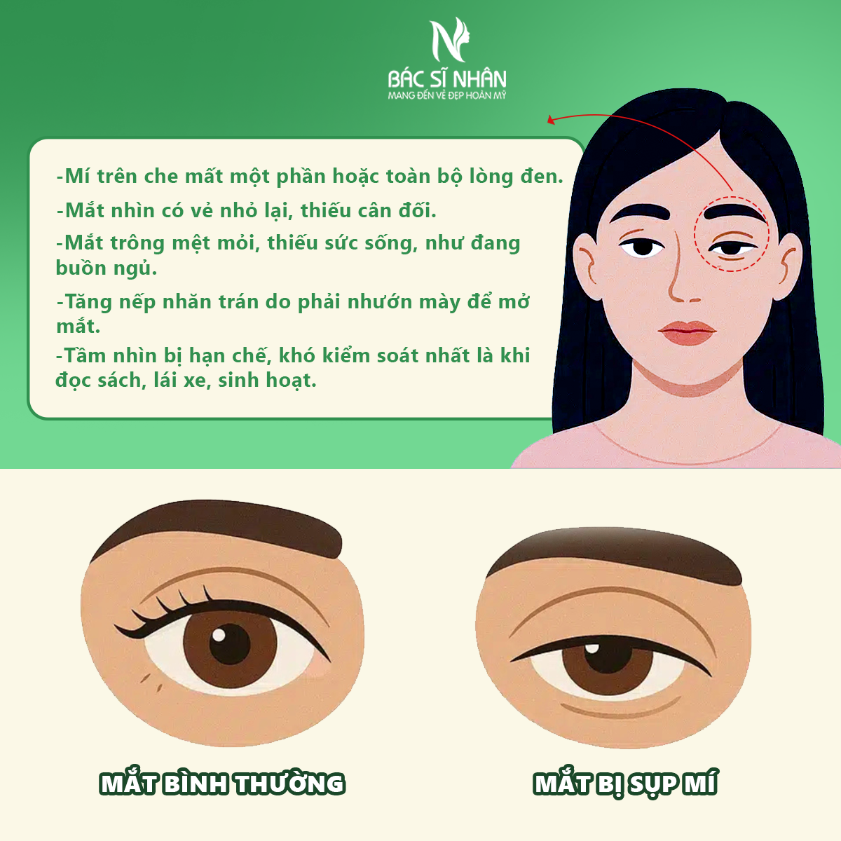 SỤP MÍ MẮT LÀ GÌ?NGUYÊN NHÂN VÀ CÁCH ĐIỀU TRỊ