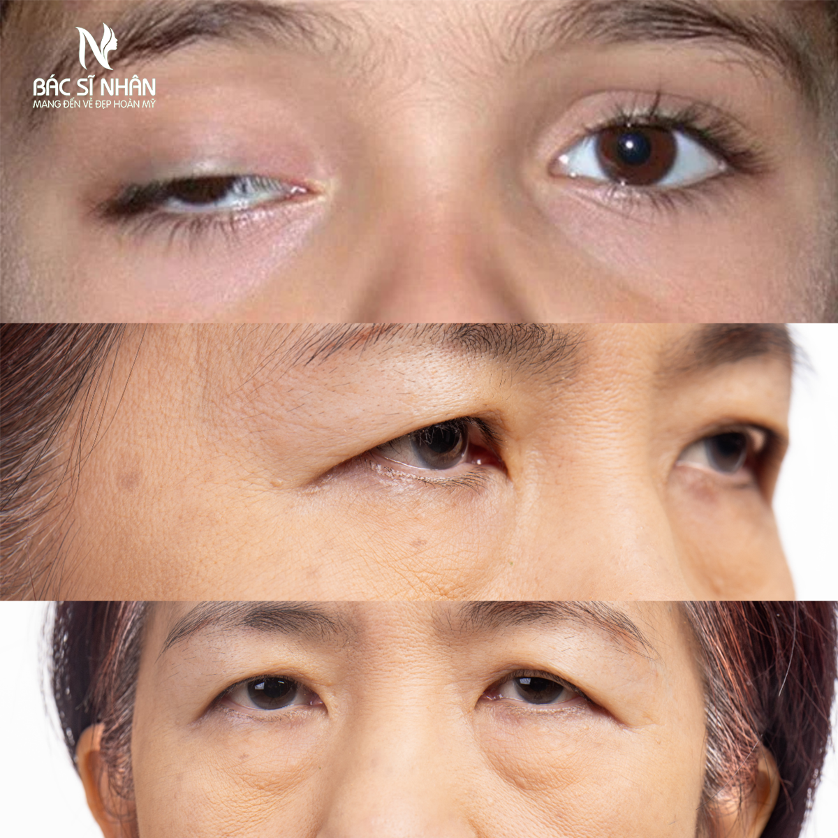 SỤP MÍ MẮT LÀ GÌ? NGUYÊN NHÂN CÁCH ĐIỀU TRỊ