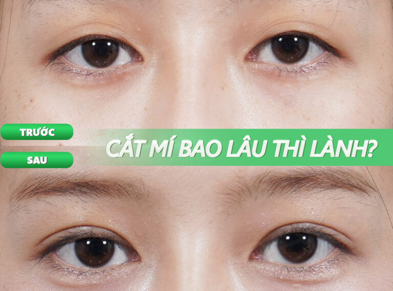 CẮT MÍ BAO LÂU THÌ LÀNH? GIẢI ĐÁP CHI TIẾT VÀ CÁCH CHĂM SÓC ĐÚNG CÁCH