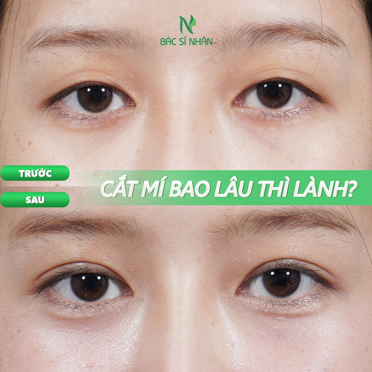 CẮT MÍ BAO LÂU THÌ LÀNH? GIẢI ĐÁP CHI TIẾT VÀ CÁCH CHĂM SÓC ĐÚNG CÁCH