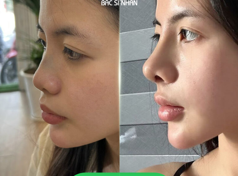 GIÁ NÂNG MŨI HIỆN NAY: CÁC YẾU TỔ ẢNH HƯỞNG ĐẾN CHI PHÍ