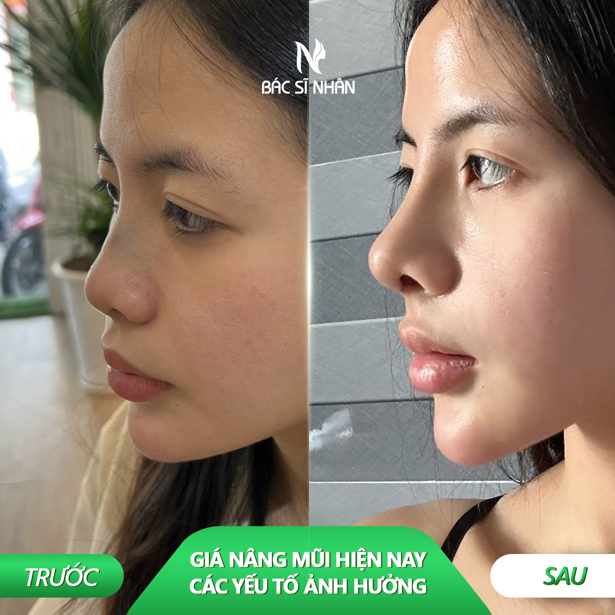 GIÁ NÂNG MŨI HIỆN NAY: CÁC YẾU TỔ ẢNH HƯỞNG ĐẾN CHI PHÍ