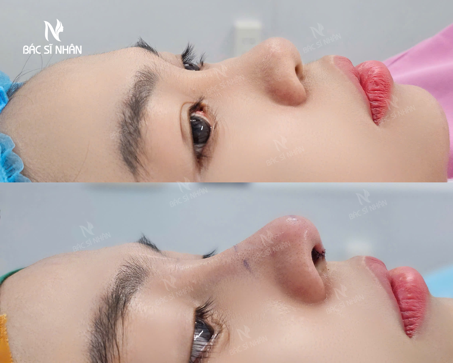 NÂNG MŨI CÓ BỊ KÉO MẮT KHÔNG? NGUYÊN NHÂN & CÁCH KHẮC PHỤC HIỆU QUẢ