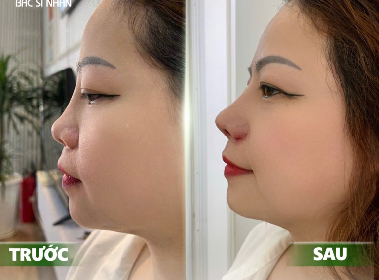 NÂNG MŨI CÓ BỊ KÉO MẮT KHÔNG? NGUYÊN NHÂN & CÁCH KHẮC PHỤC HIỆU QUẢ