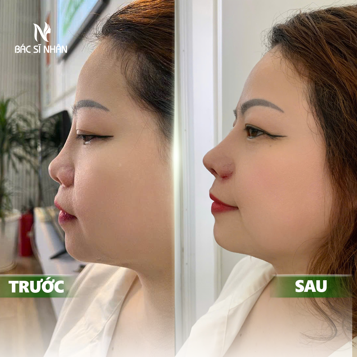 NÂNG MŨI CÓ BỊ KÉO MẮT KHÔNG? NGUYÊN NHÂN & CÁCH KHẮC PHỤC HIỆU QUẢ