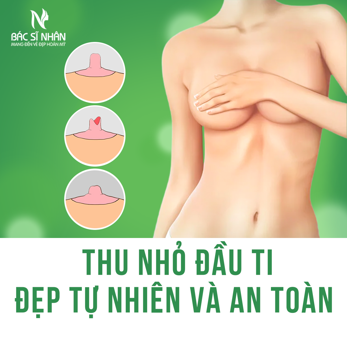 PHẪU THUẬT THU NHỎ ĐẦU TI ĐẸP TỰ NHIÊN VÀ AN TOÀN