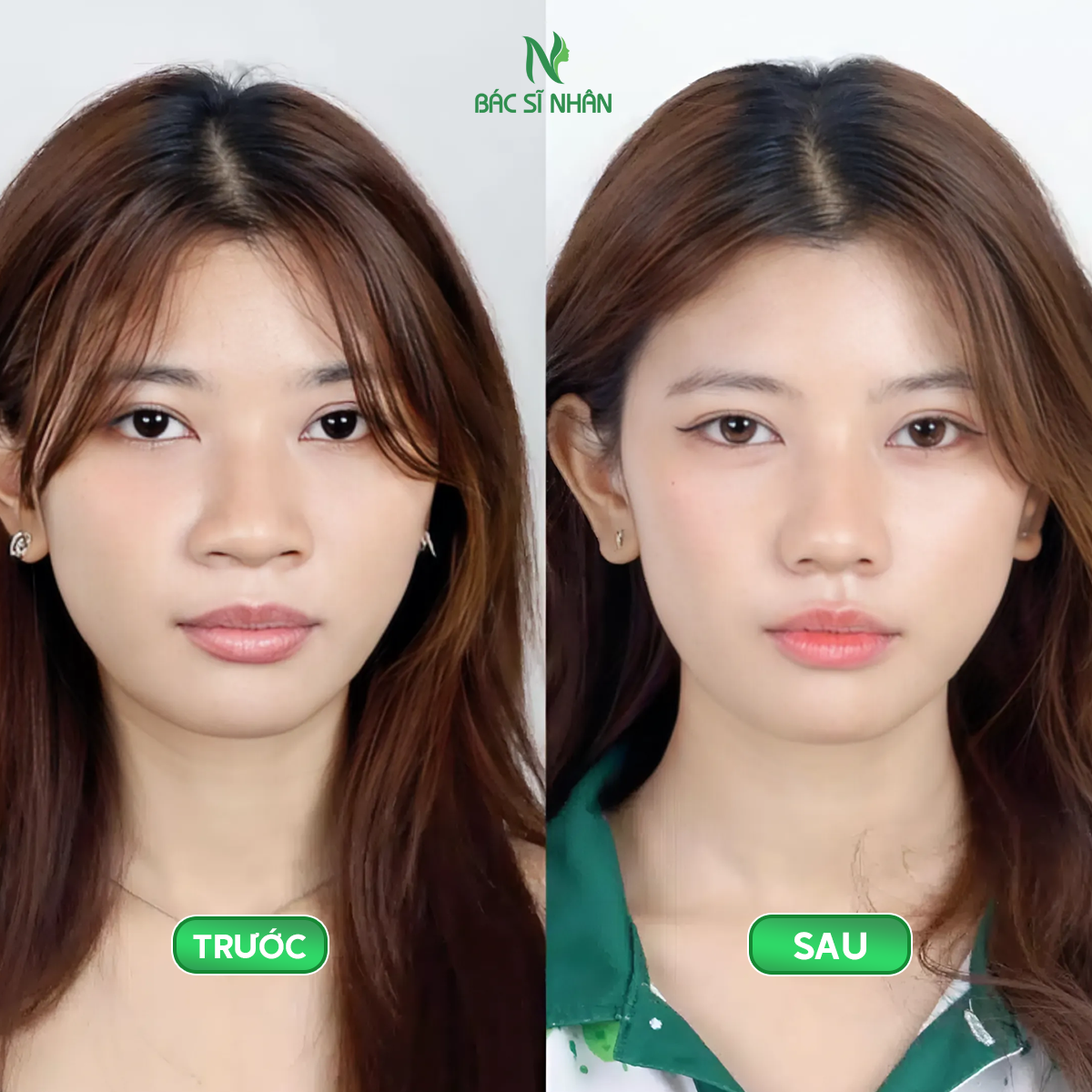 PHƯƠNG PHÁP THU NHỎ ĐẦU MŨI - GIẢI PHÁP CHO DÁNG MŨI THON GỌN, TỰ NHIÊN