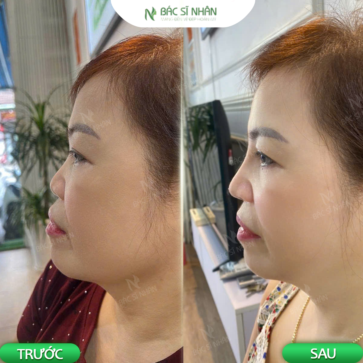 SỬA MŨI SAU KHI NÂNG CÓ ĐƯỢC KHÔNG? THỜI GIAN VÀ NHỮNG ĐIỀU CẦN BIẾT