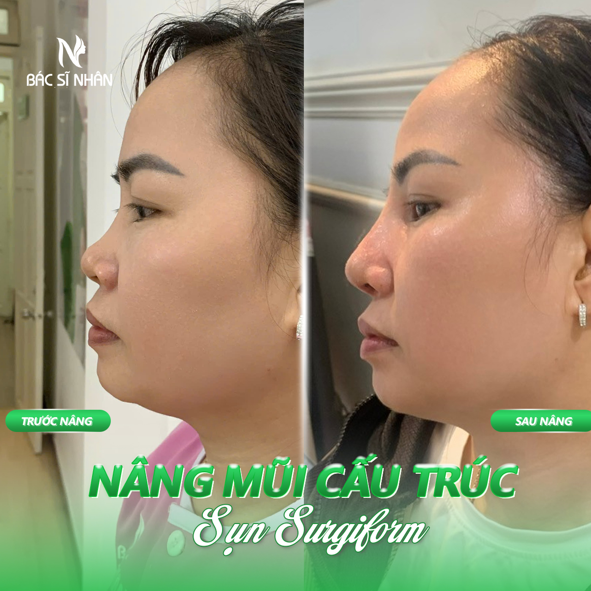 So sánh sụn Surgiform và sụn Silicone