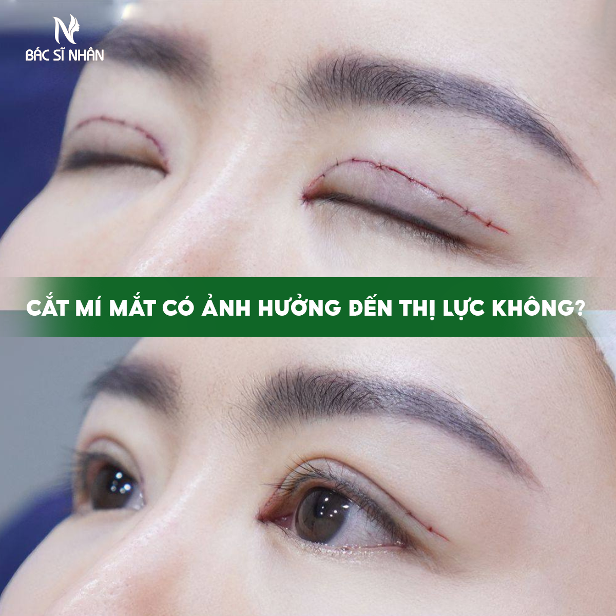 CẮT MÍ MẮT CÓ ẢNH HƯỞNG ĐẾN THỊ LỰC KHÔNG
