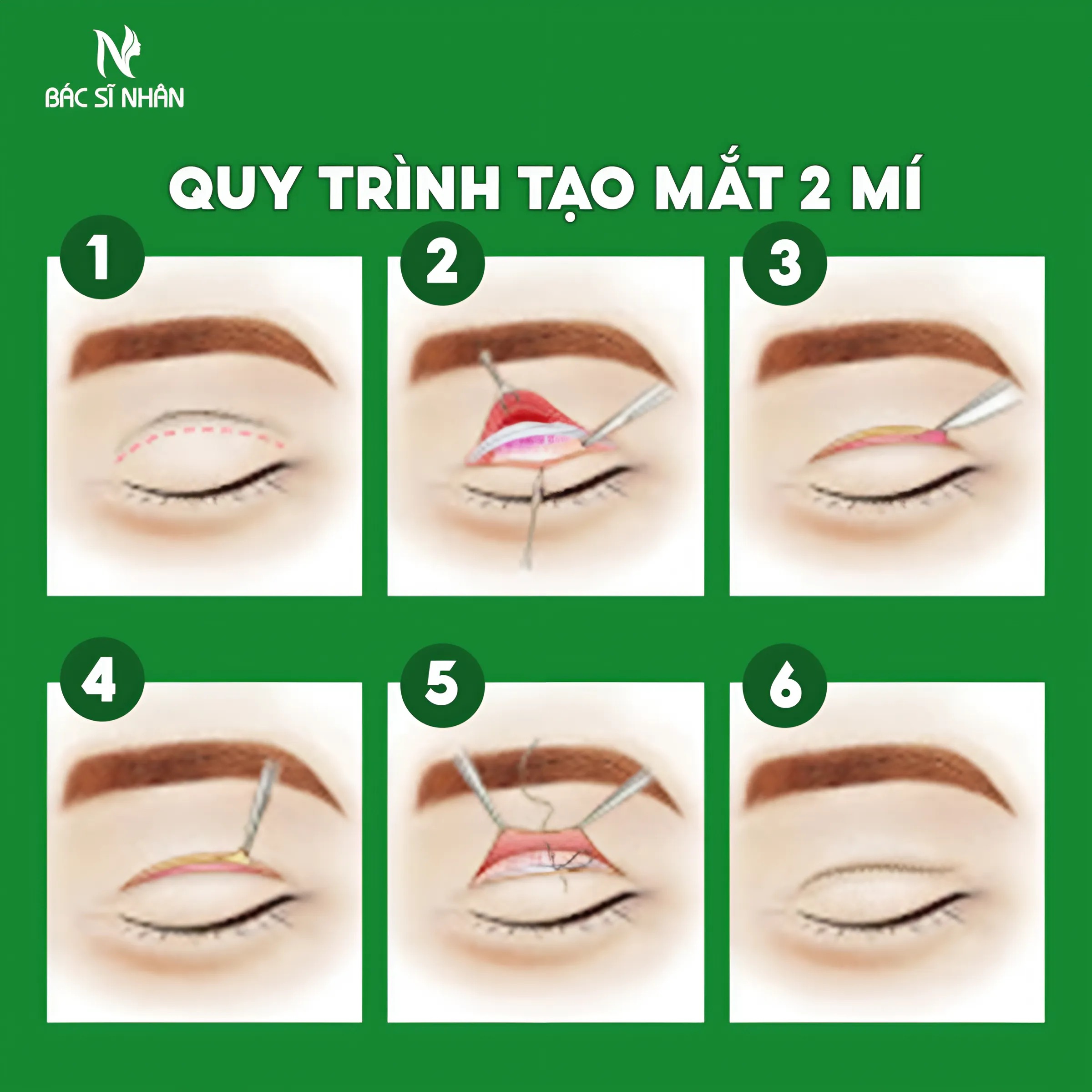 CẮT MÍ MẮT CÓ ẢNH HƯỞNG ĐẾN THỊ LỰC KHÔNG