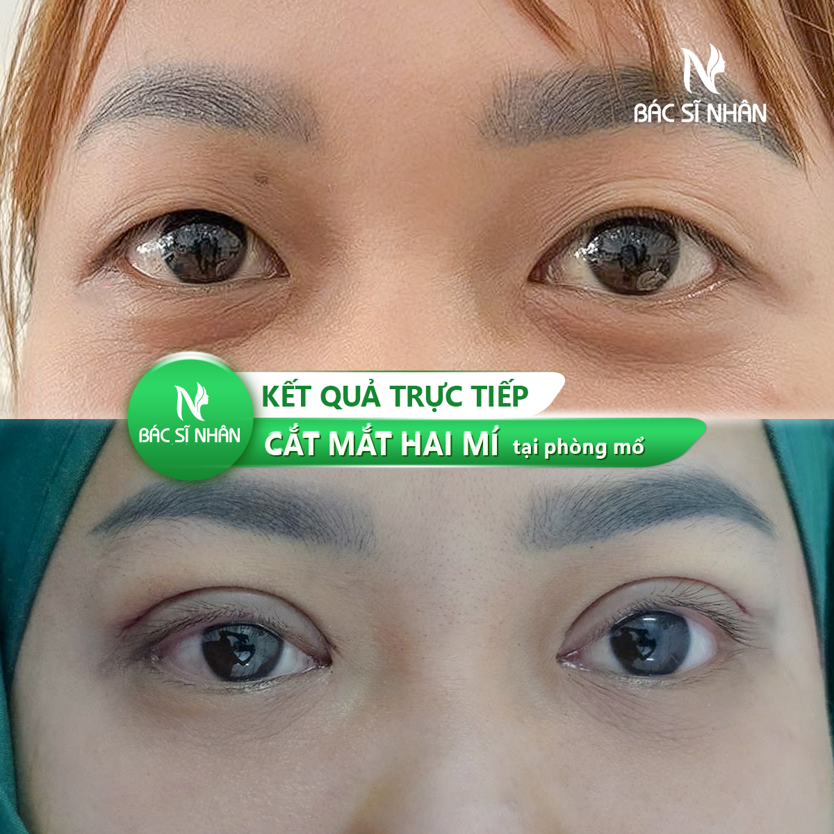 CẮT MÍ MẮT CÓ ẢNH HƯỞNG ĐẾN THỊ LỰC KHÔNG