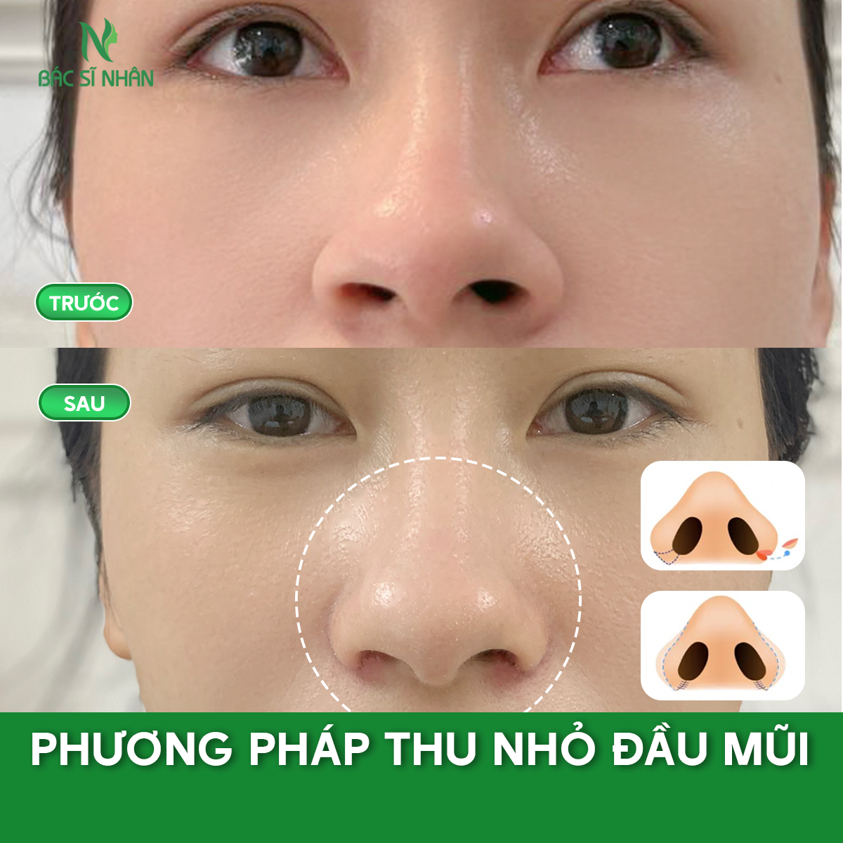 PHƯƠNG PHÁP THU NHỎ ĐẦU MŨI - GIẢI PHÁP CHO DÁNG MŨI THON GỌN, TỰ NHIÊN