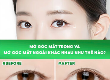 MỞ GÓC MẮT TRONG VÀ MỞ GÓC MẮT NGOÀI KHÁC NHAU NHƯ THẾ NÀO?