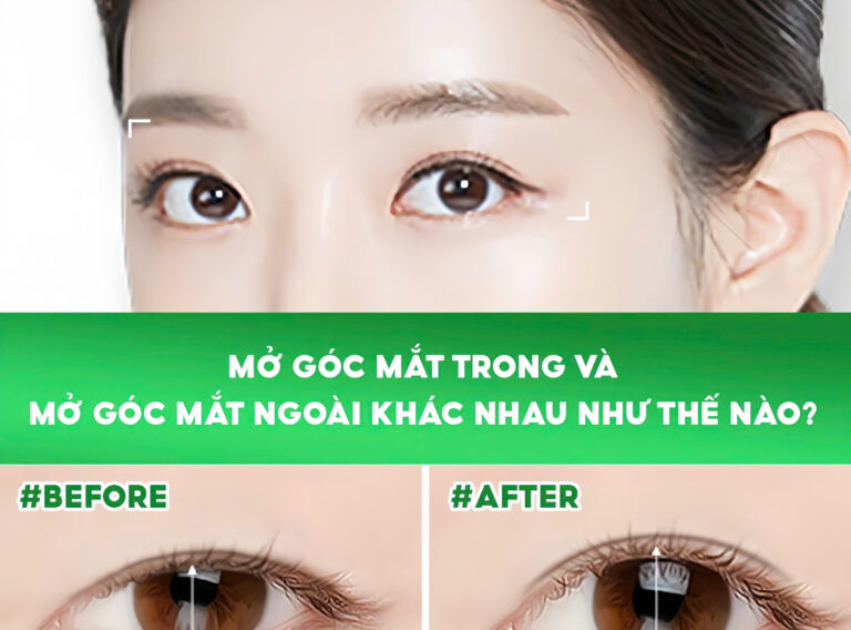 MỞ GÓC MẮT TRONG VÀ MỞ GÓC MẮT NGOÀI KHÁC NHAU NHƯ THẾ NÀO?