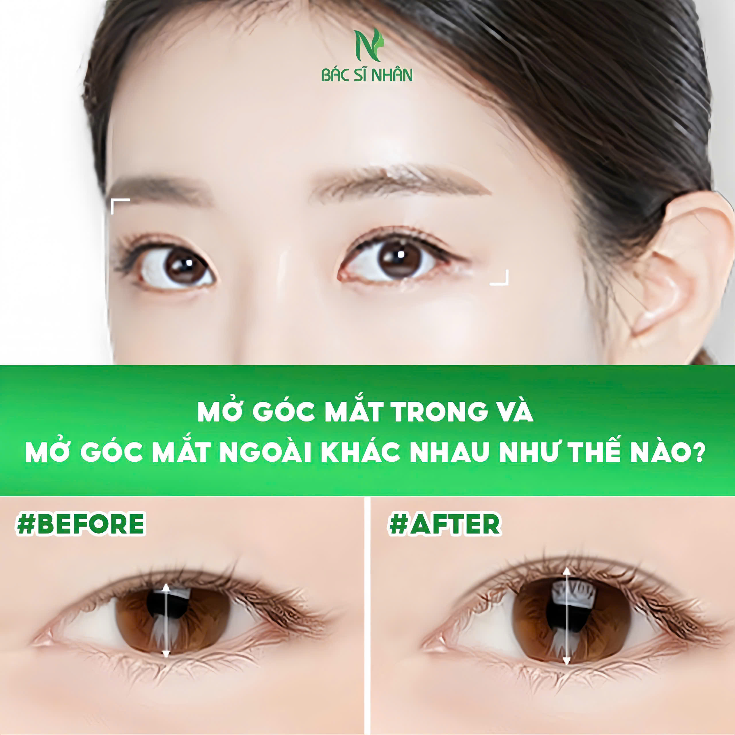 MỞ GÓC MẮT TRONG VÀ MỞ GÓC MẮT NGOÀI KHÁC NHAU NHƯ THẾ NÀO?