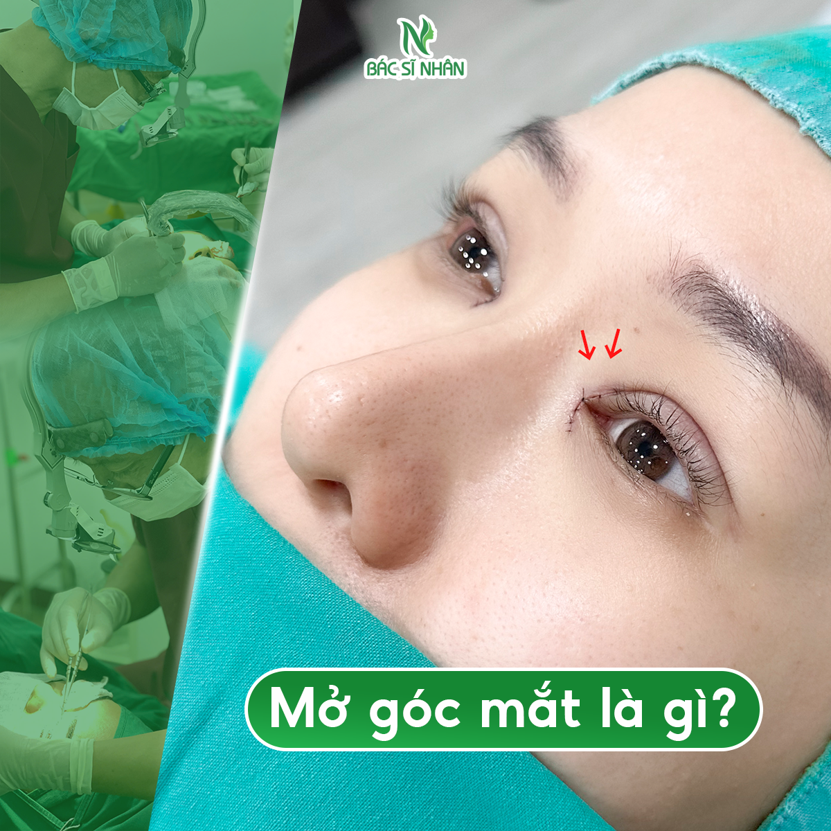 MỞ GÓC MẮT TRONG VÀ MỞ GÓC MẮT NGOÀI KHÁC NHAU NHƯ THẾ NÀO?