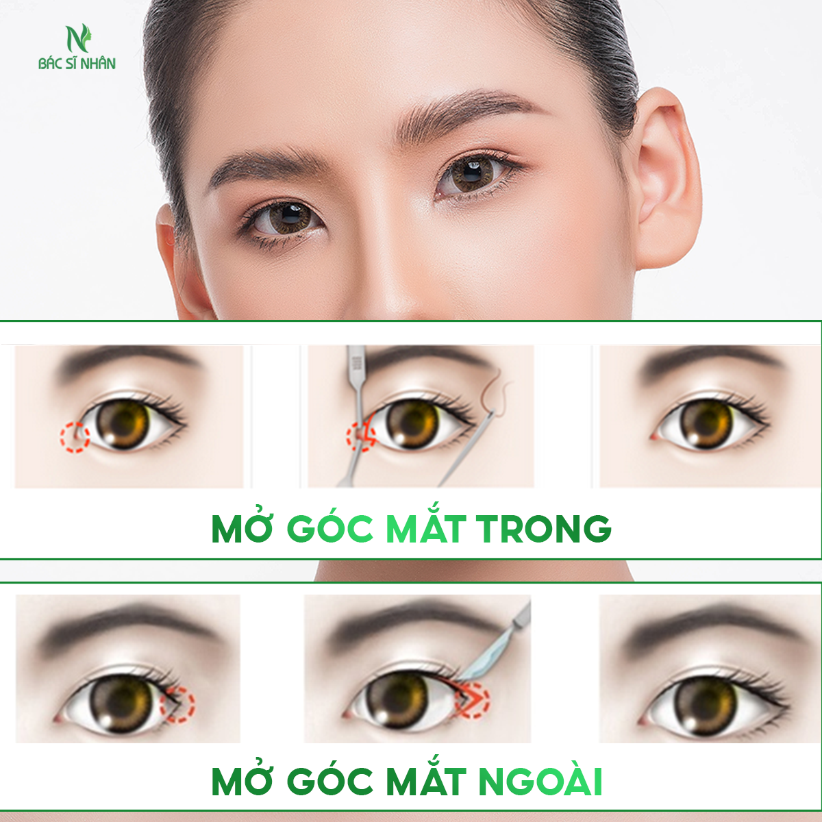 MỞ GÓC MẮT TRONG VÀ MỞ GÓC MẮT NGOÀI KHÁC NHAU NHƯ THẾ NÀO?