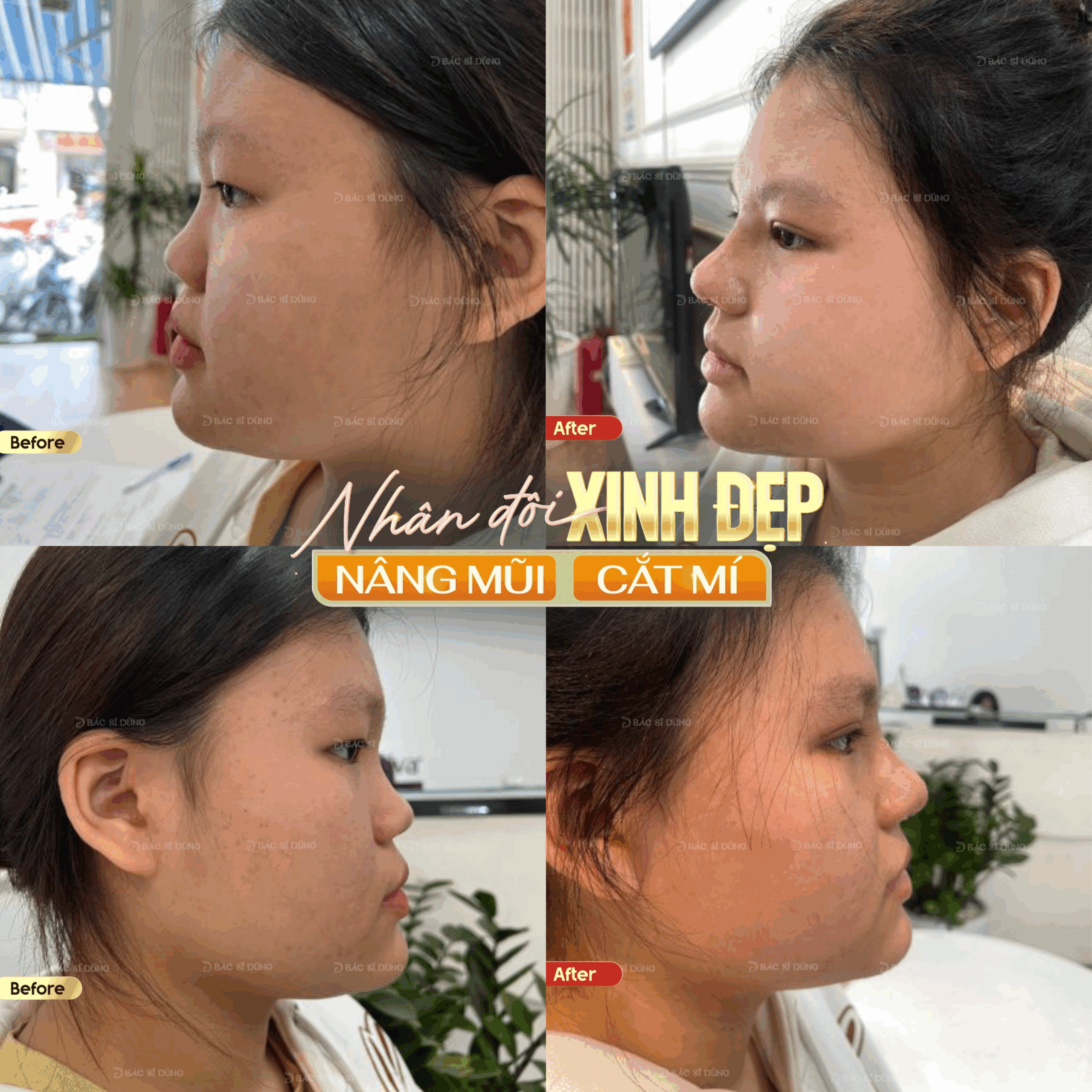 Ưu Đãi Đặc Biệt Dành Cho Học Sinh – Sinh Viên: Nâng Mũi Chỉ Còn 21 Triệu 3 mui 15 copy scaled