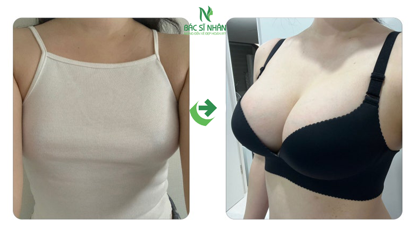 SAU NÂNG BAO LÂU THÌ NGỰC MỀM TỰ NHIÊN
