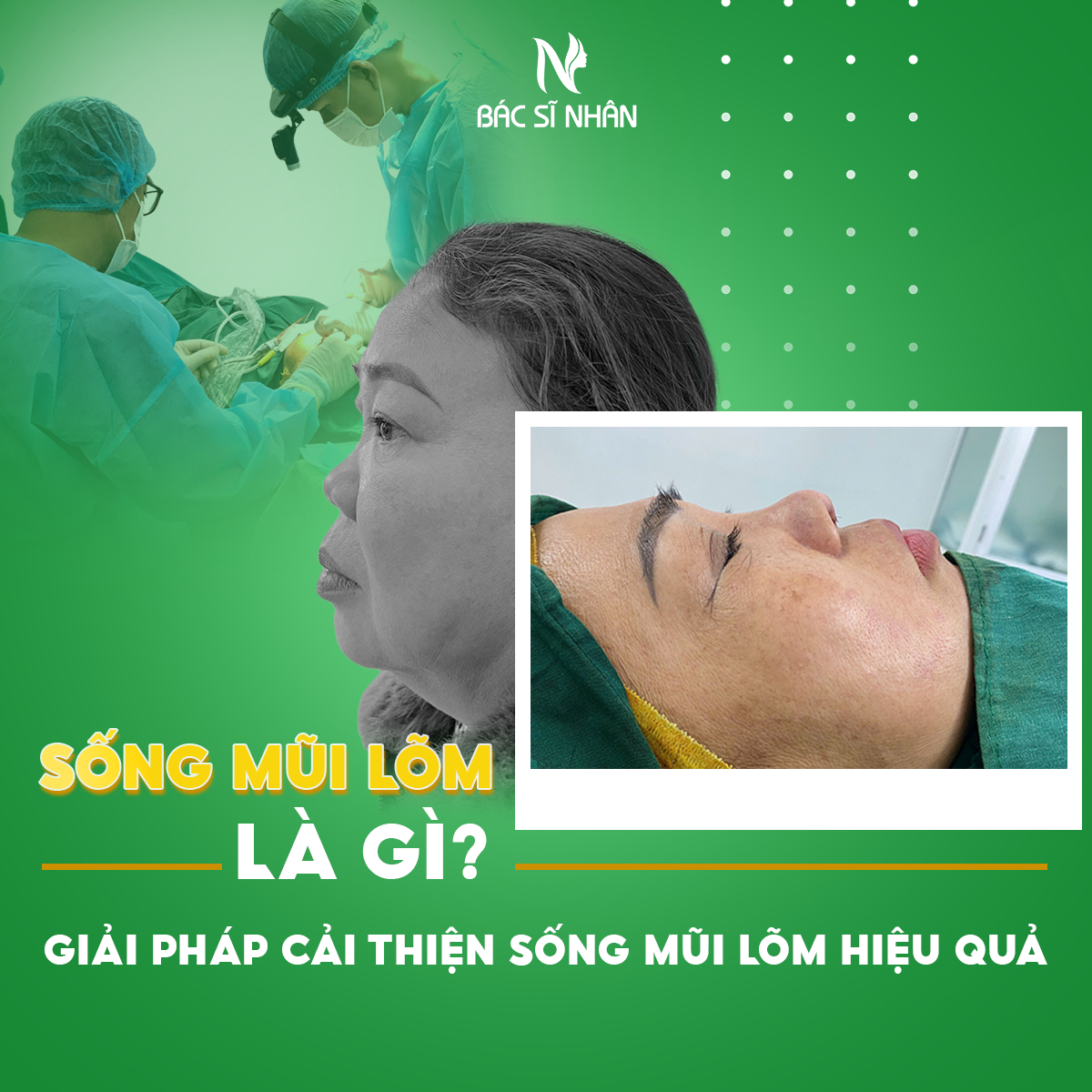 SỐNG MŨI LÕM LÀ GÌ? GIẢI PHÁP CẢI THIỆN SÓNG MŨI LÕM HIỆU QUẢ