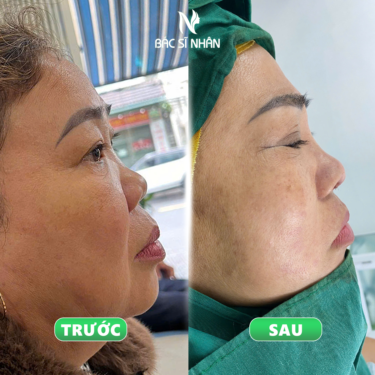 SÓNG MŨI LÕM LÀ GÌ/ GIẢI PHÁP CẢI THIỆN SÓNG MŨI LÕM HIỆU QUẢ