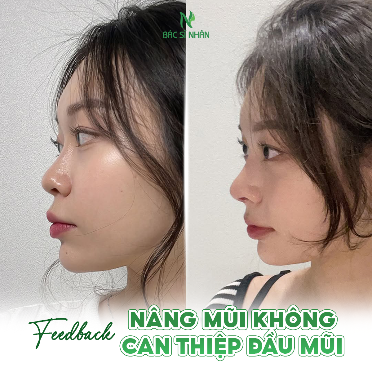 NÂNG SÓNG MŨI KHÔNG CAN THIỆP ĐẦU MŨI LÀ GÌ?