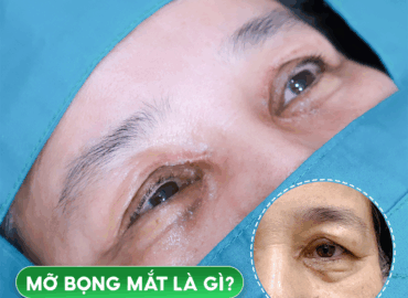 MỠ BỌNG MẮT LÀ GÌ? PHƯƠNG PHÁP CẢI THIỆN HIỆU QUẢ