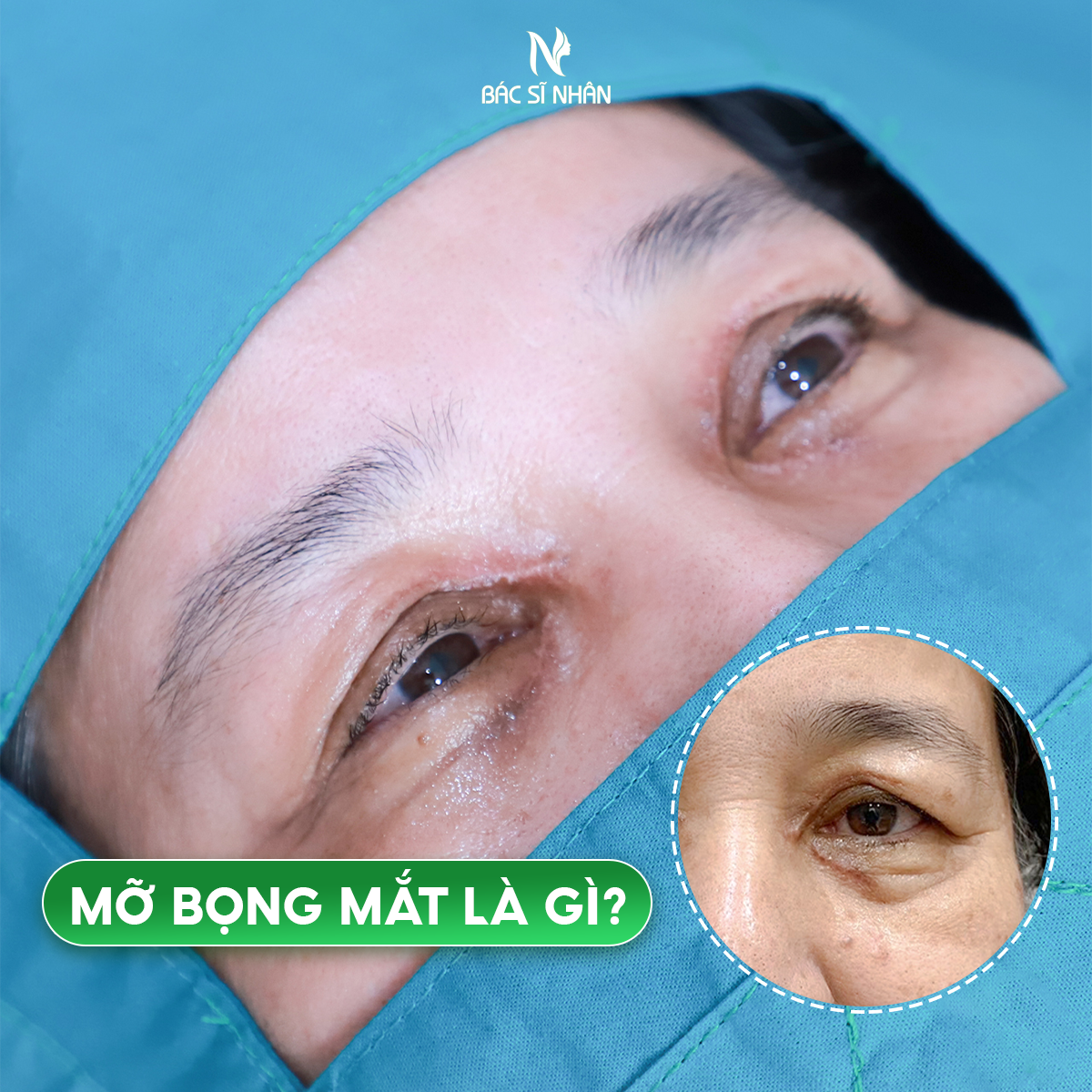 MỠ BỌNG MẮT LÀ GÌ? PHƯƠNG PHÁP CẢI THIỆN HIỆU QUẢ