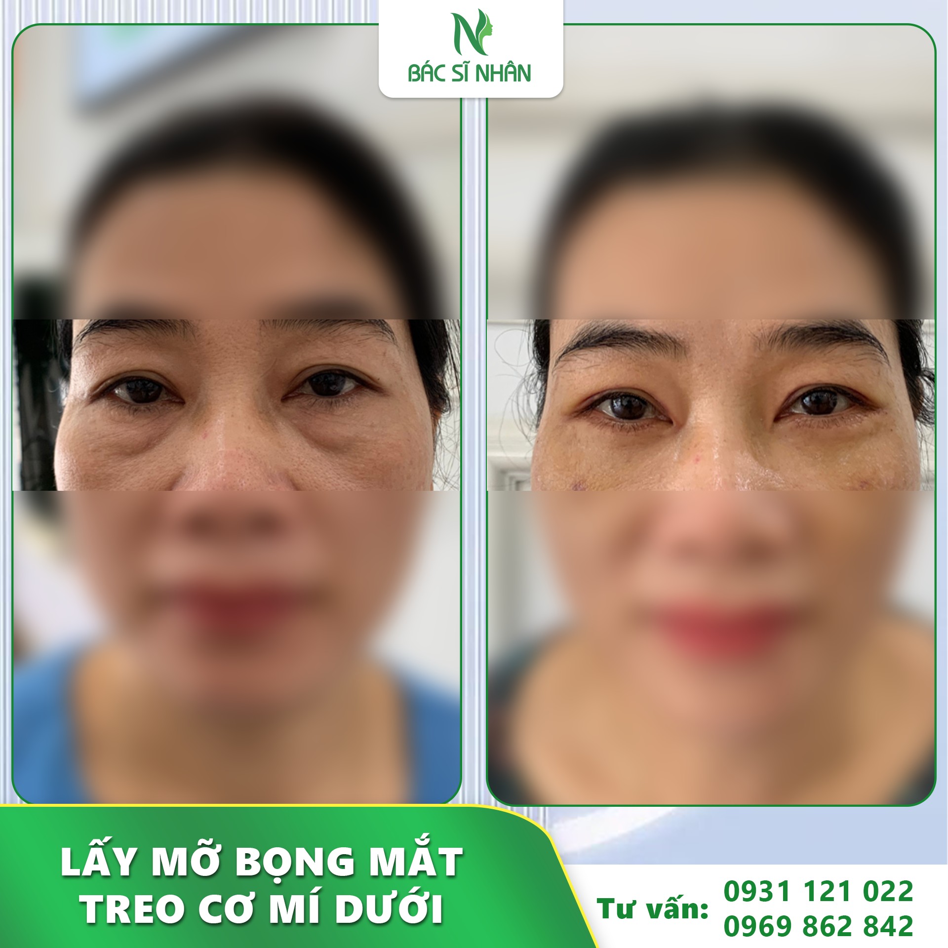 mo bong mat la gi 3