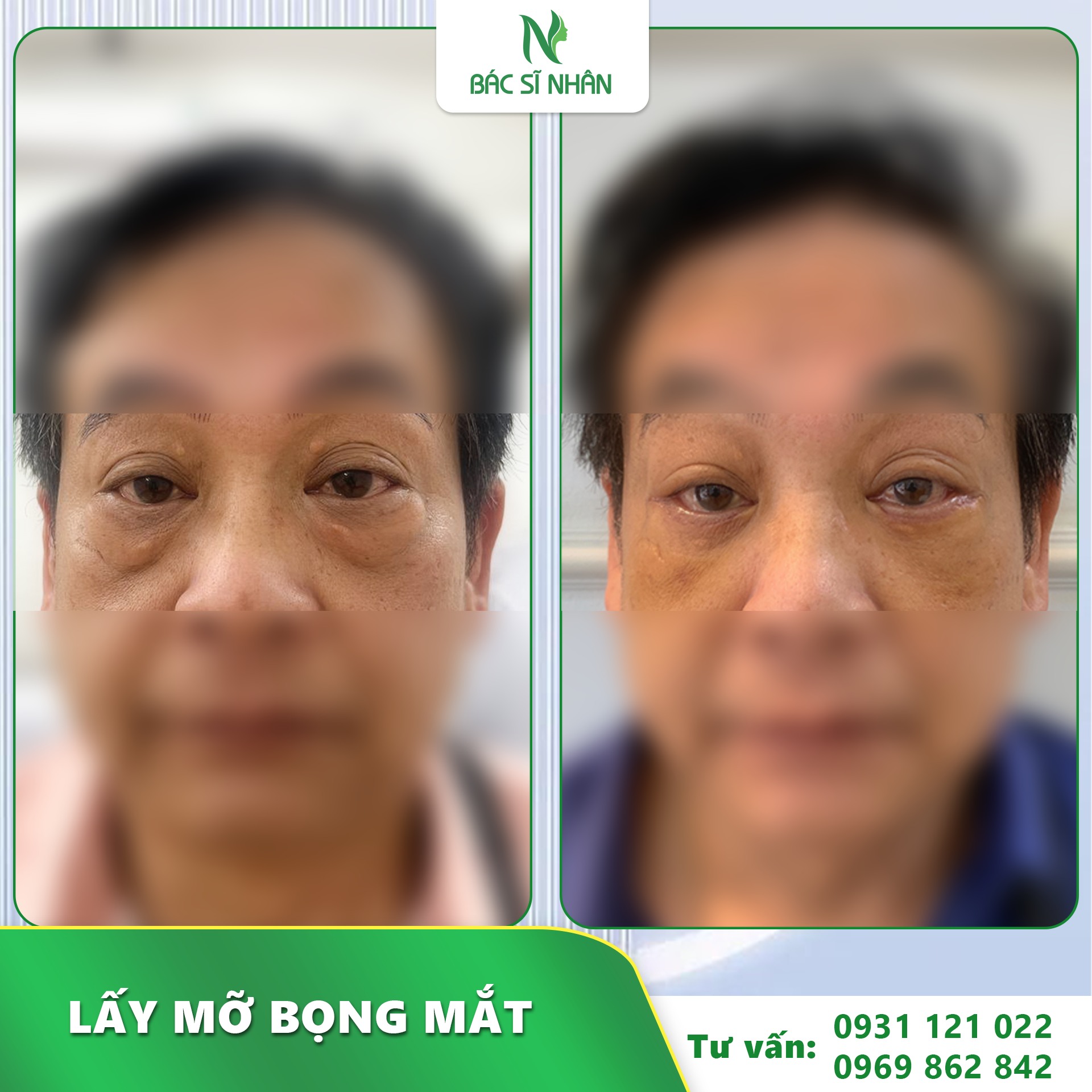 MỠ BỌNG MẮT LÀ GÌ?  PHƯƠNG PHÁP KHẮC PHỤC HIỆU QUẢ