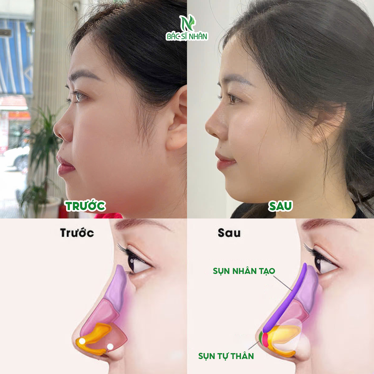NÂNG MŨI CẤU TRÚC TẠI ĐÀ NẴNG