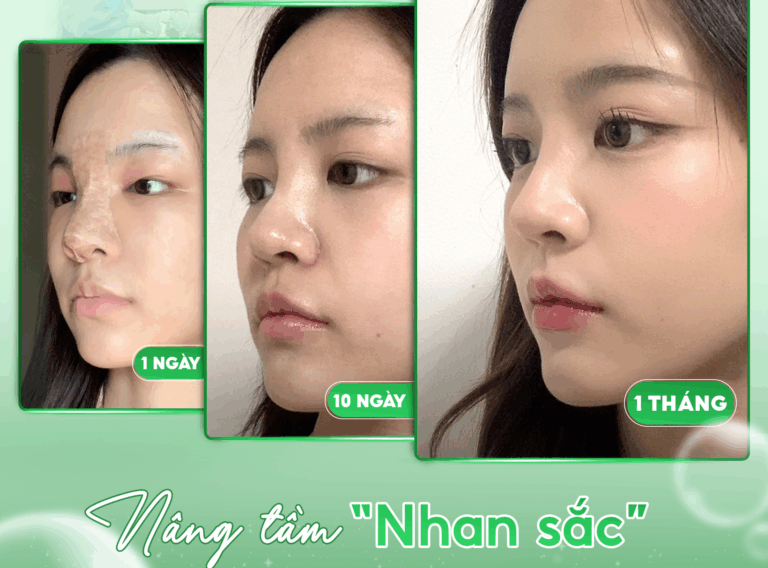 NÂNG MŨI CẤU TRÚC TẠI ĐÀ NẴNG