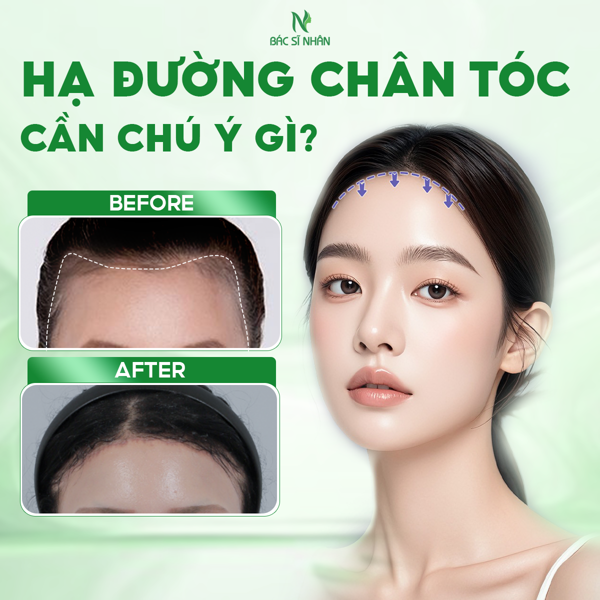 HẠ ĐƯỜNG CHÂN TÓC CẦN CHÚ Ý GÌ