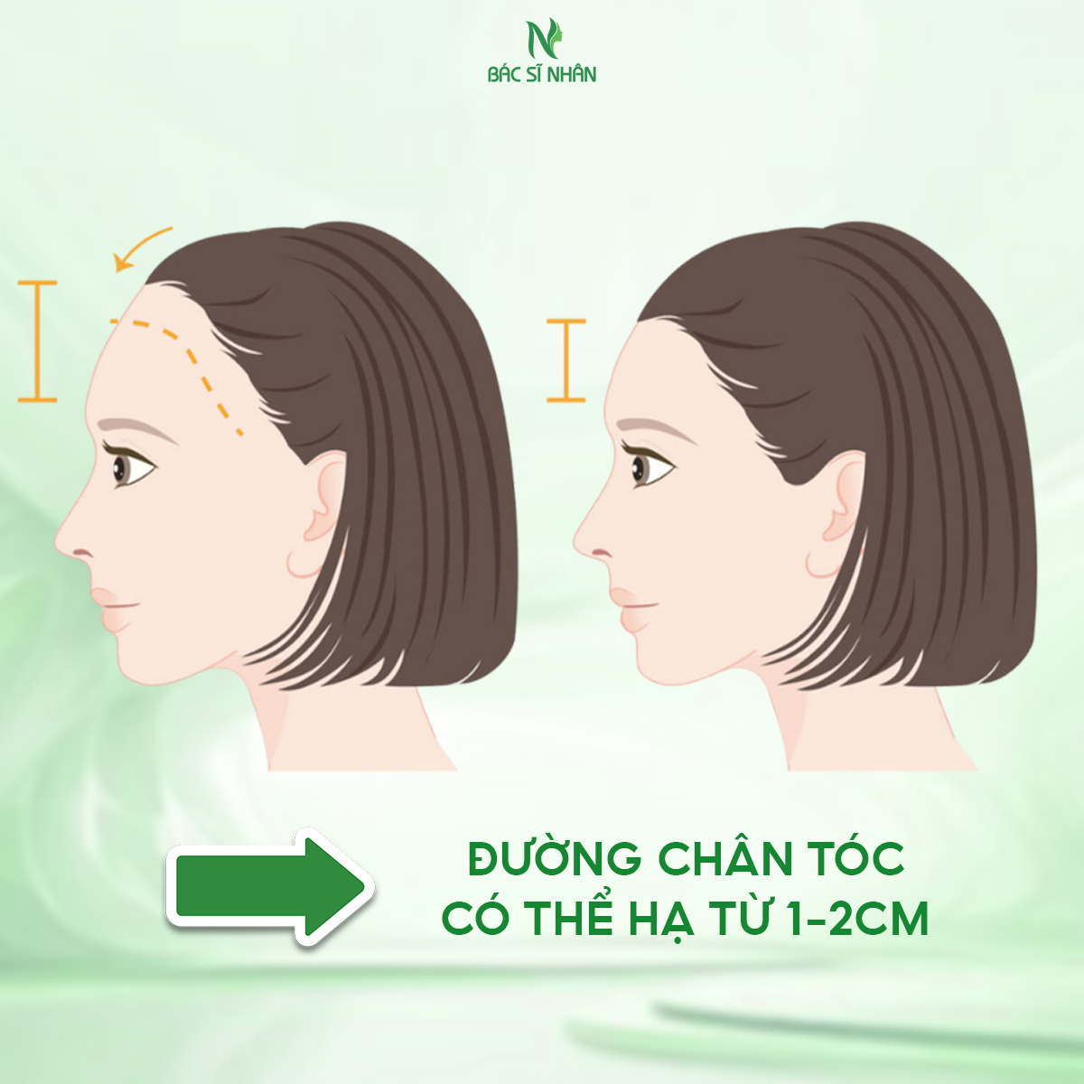 HẠ ĐƯỜNG CHÂN TÓC CẦN CHÚ Ý GÌ