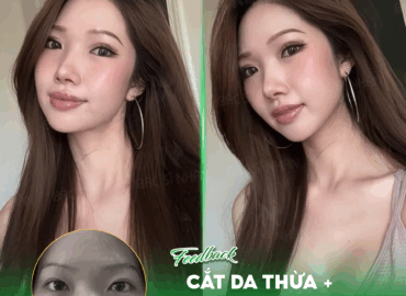 cat-da-thua-mi-mat-la-gi CẮT DA THỪA MÍ MẮT LÀ GÌ