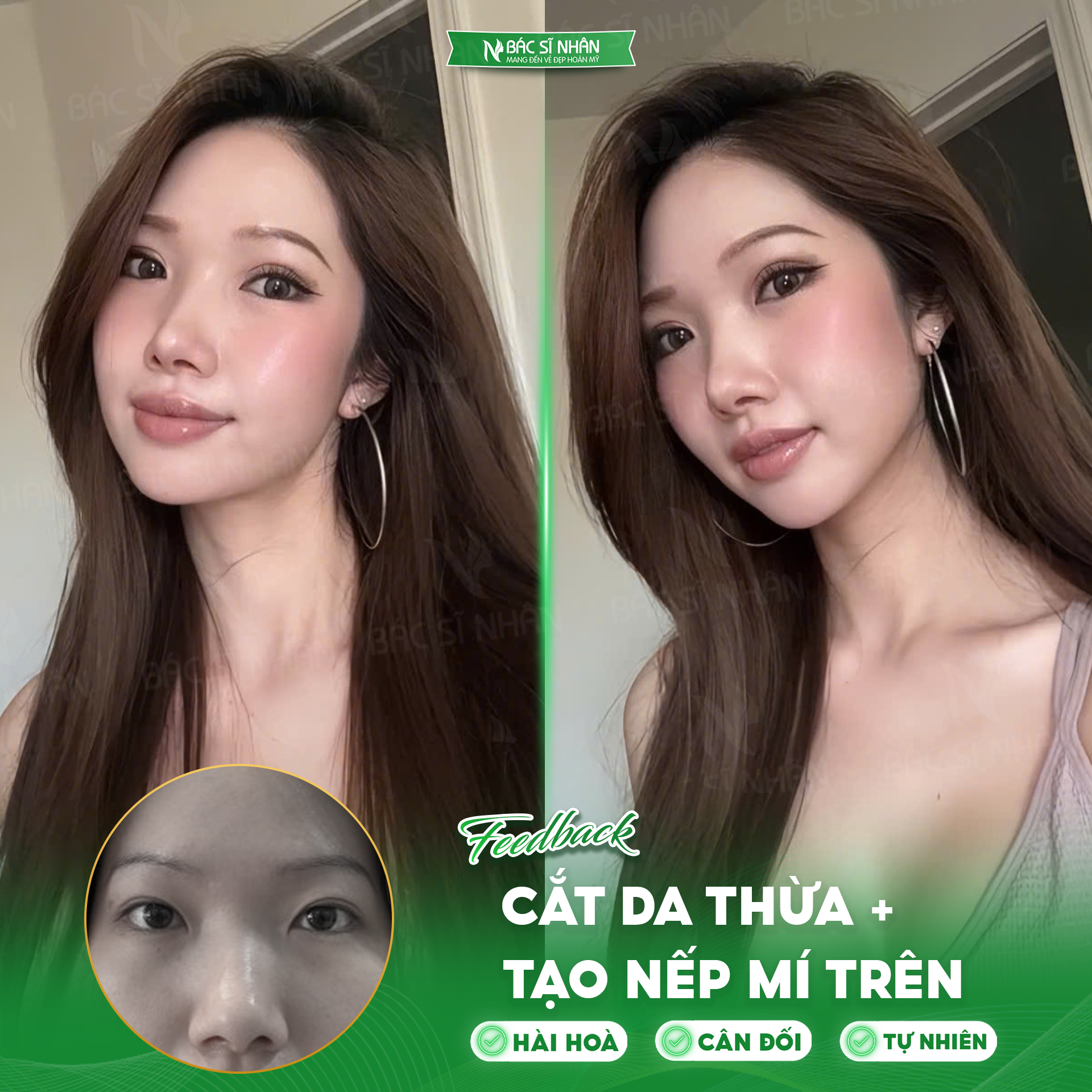 CẮT DA THỪA MÍ MẮT LÀ GÌ