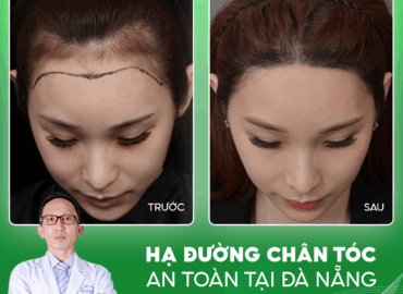 ha-duong-chan-toc-an-toan-tai-da-nang-1 HẠ ĐƯỜNG CHÂN TÓC AN TOÀN TẠI ĐÀ NẴNG