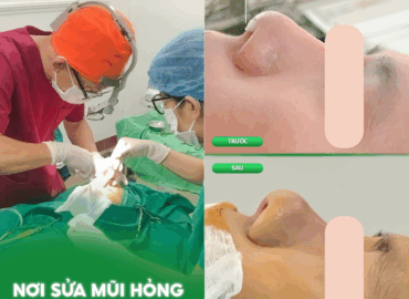NƠI SỬA MŨI HỎNG TẠI ĐÀ NẴNG