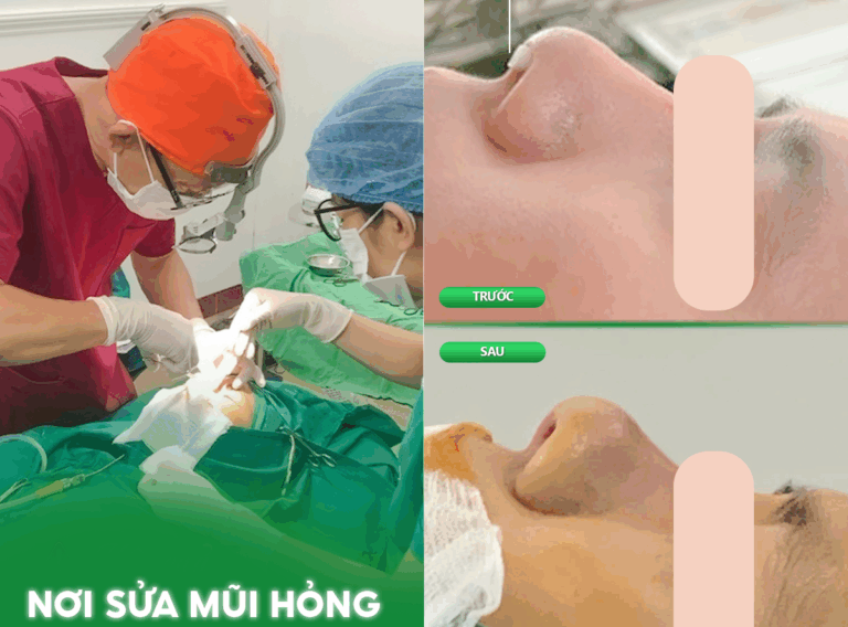 NƠI SỬA MŨI HỎNG TẠI ĐÀ NẴNG