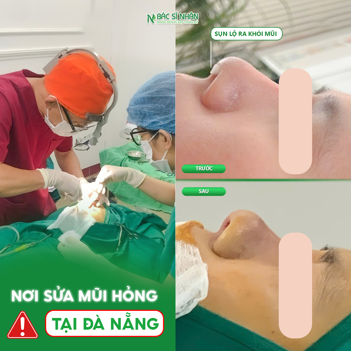 NƠI SỬA MŨI HỎNG TẠI ĐÀ NẴNG
