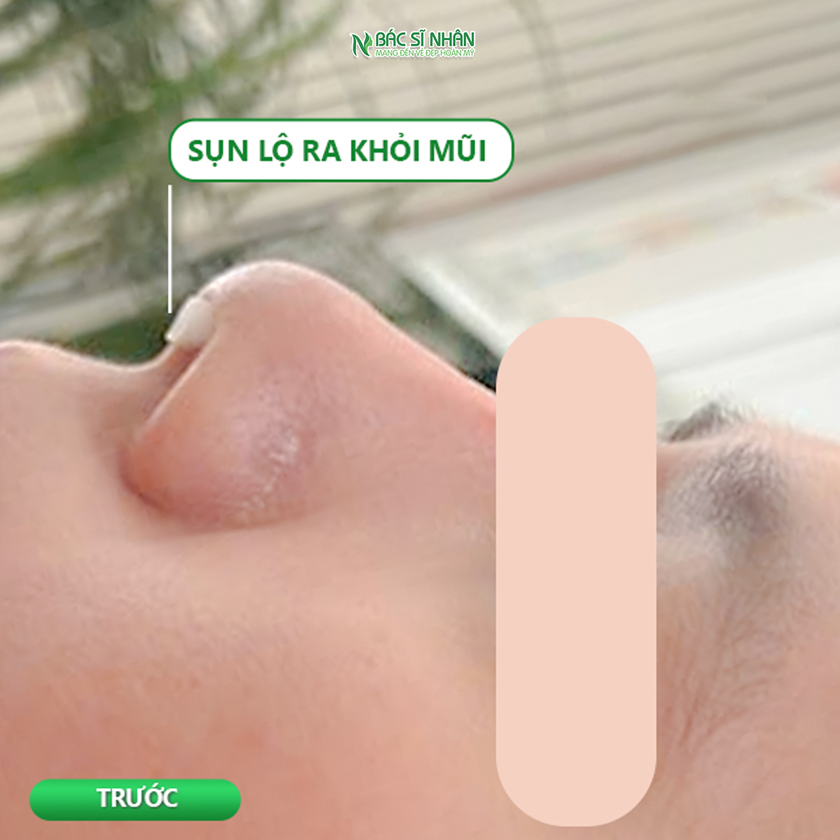 NƠI SỬA MŨI HỎNG TẠI ĐÀ NẴNG