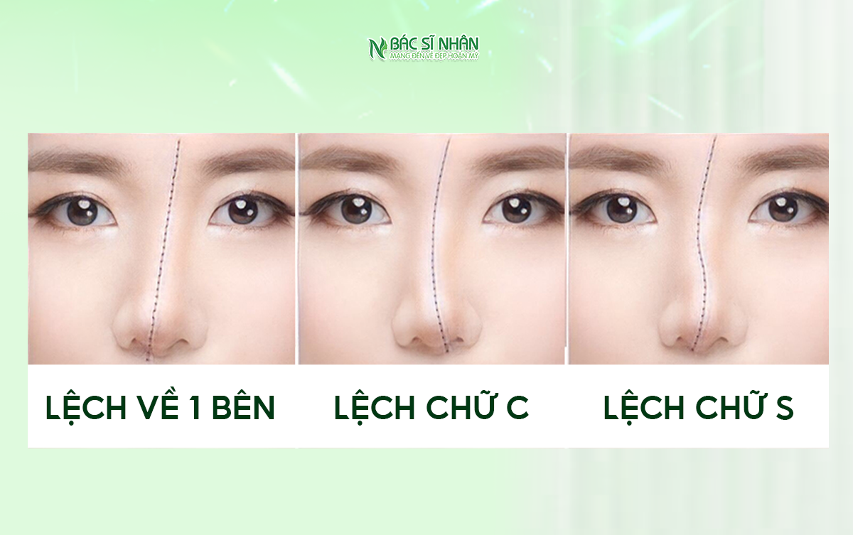 5 DẤU HIỆU MŨI SAU NÂNG ĐANG BỊ HỎNG - CÁCH XỬ LÝ ĐÚNG