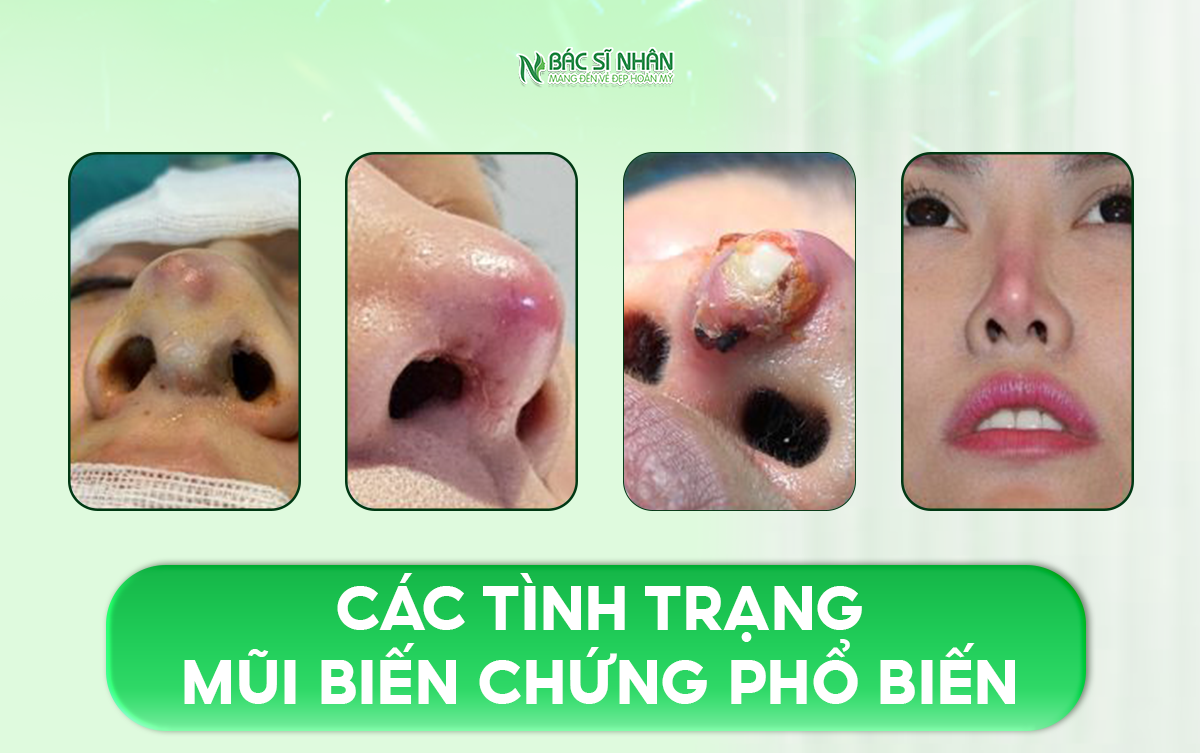 5 DẤU HIỆU MŨI SAU NÂNG ĐANG BỊ HỎNG - CÁCH XỬ LÝ ĐÚNG
